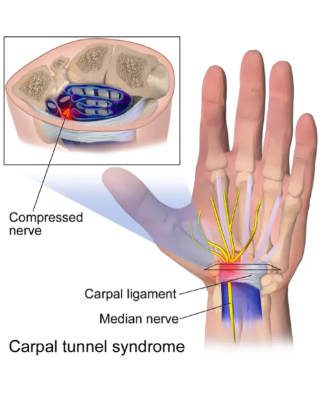 Carpal Tunnel