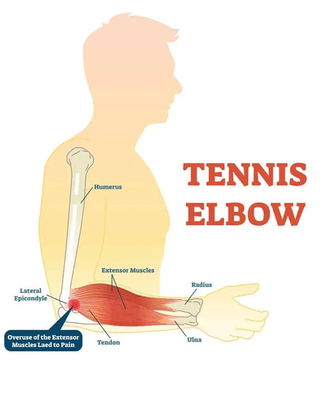 Tennis Elbow